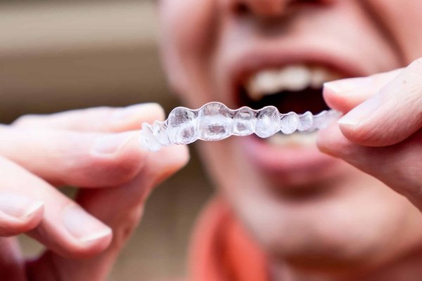 Comparaison entre Dr. Smile et Invisalign : Quelle option est la meilleure pour vous ?